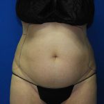 Liposuction Before & After Patient #3138