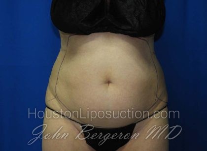 Liposuction Before & After Patient #3138