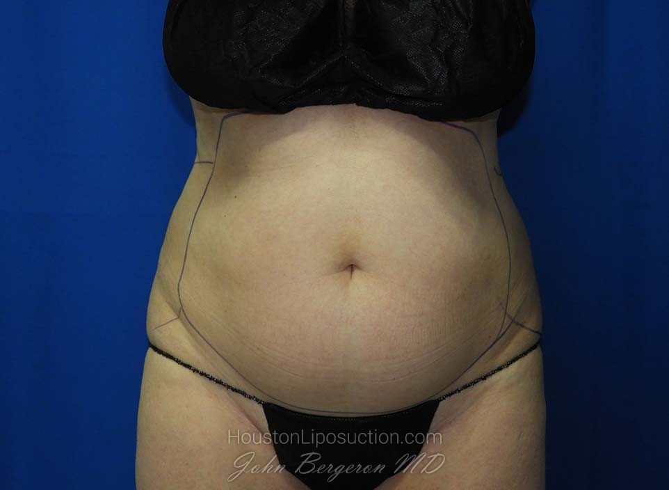 Liposuction Before & After Patient #3138