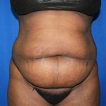 Liposuction Before & After Patient #3147