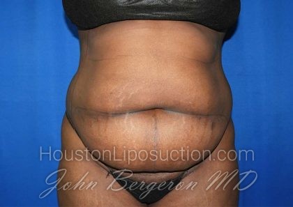 Liposuction Before & After Patient #3147