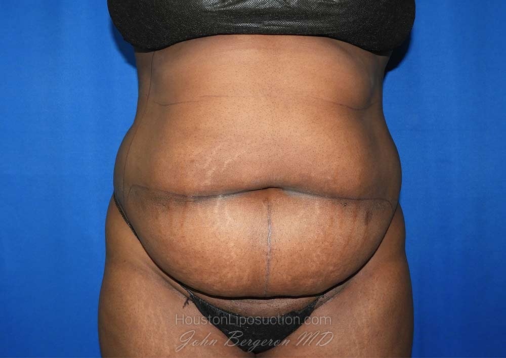 Liposuction Before & After Patient #3147