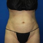 Liposuction Before & After Patient #3138