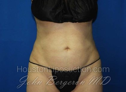 Liposuction Before & After Patient #3138