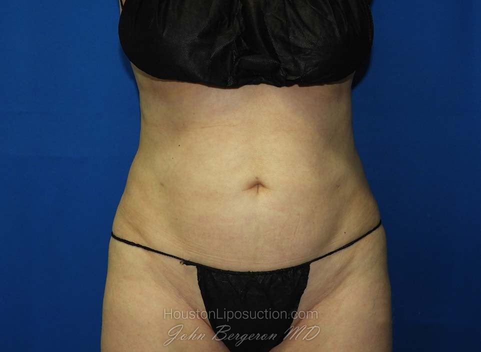 Liposuction Before & After Patient #3138