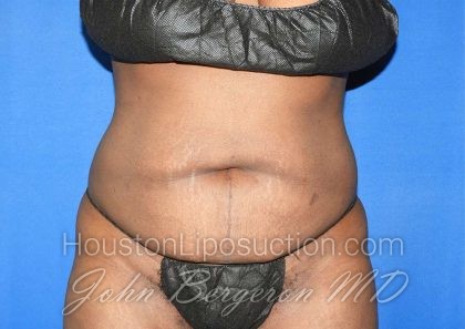 Liposuction Before & After Patient #3147