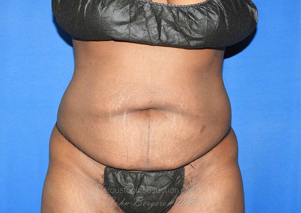 Liposuction Before & After Patient #3147