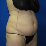 Liposuction Before & After Patient #3138