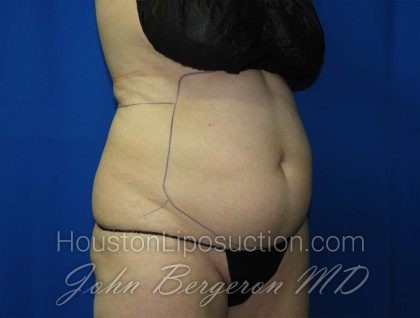 Liposuction Before & After Patient #3138