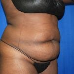 Liposuction Before & After Patient #3147