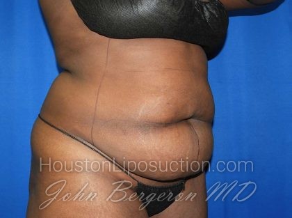 Liposuction Before & After Patient #3147