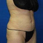 Liposuction Before & After Patient #3138