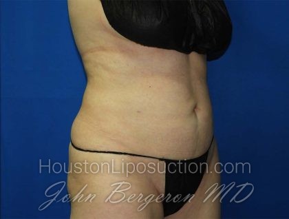 Liposuction Before & After Patient #3138