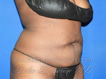 Liposuction Before & After Patient #3147