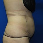 Liposuction Before & After Patient #3138