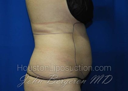 Liposuction Before & After Patient #3138