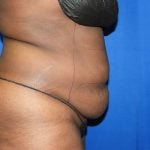 Liposuction Before & After Patient #3147