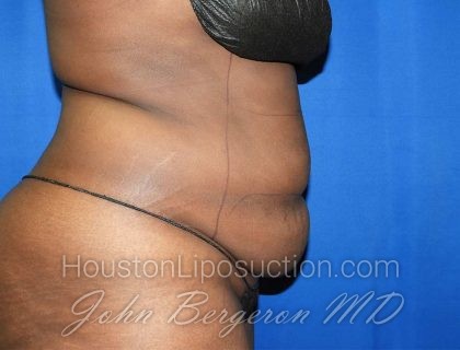 Liposuction Before & After Patient #3147