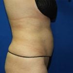 Liposuction Before & After Patient #3138