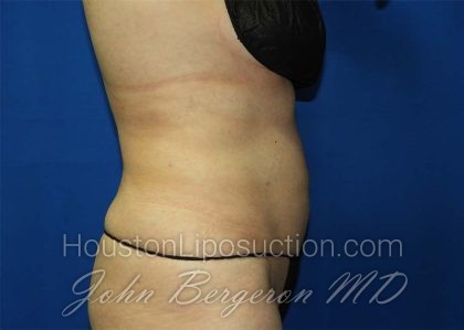 Liposuction Before & After Patient #3138