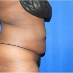 Liposuction Before & After Patient #3147