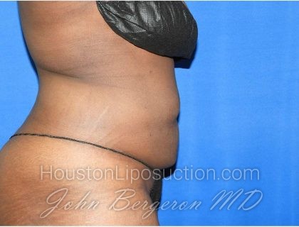 Liposuction Before & After Patient #3147