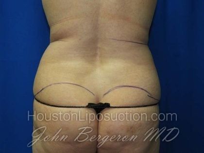 Liposuction Before & After Patient #3138