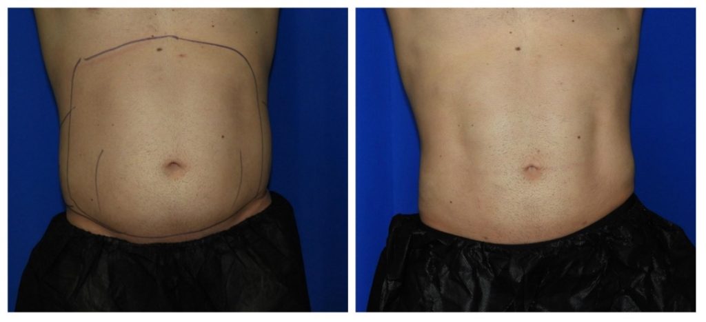 Liposuction Houston