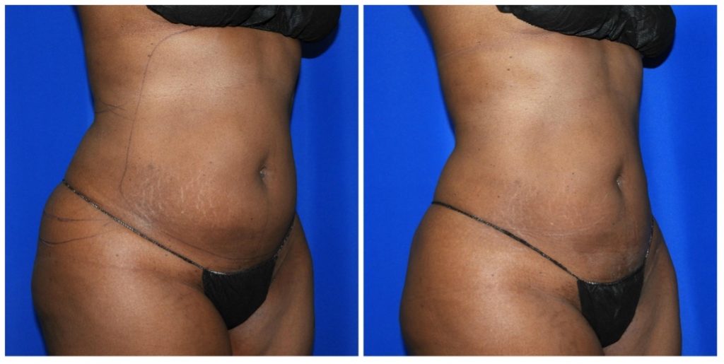 Liposuction Houston