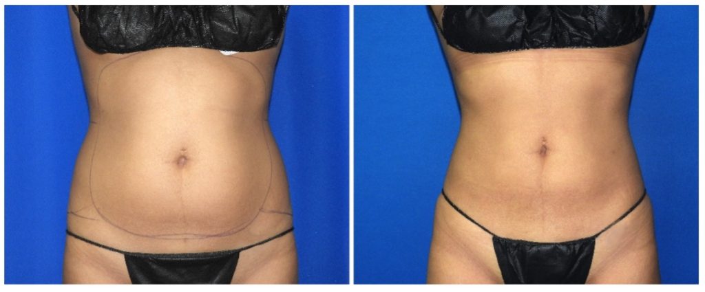 Liposuction Houston