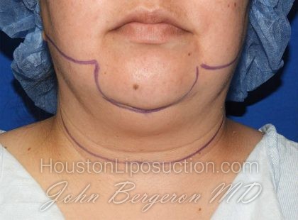 Liposuction Before & After Patient #3167