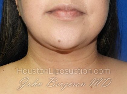 Liposuction Before & After Patient #3167