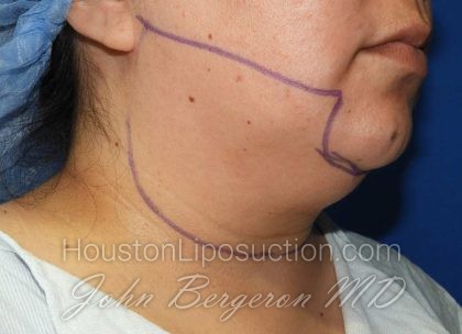 Liposuction Before & After Patient #3167