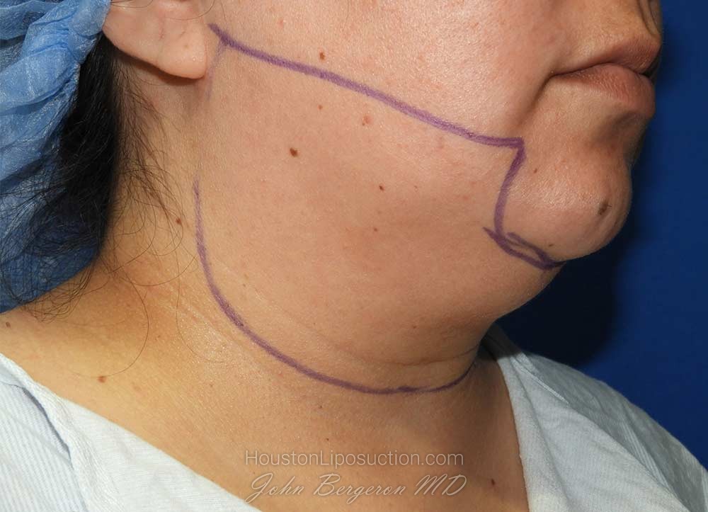 Liposuction Before & After Patient #3167