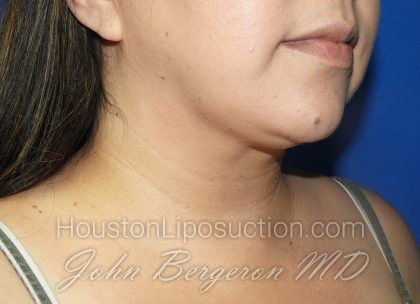Liposuction Before & After Patient #3167