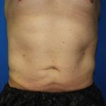 Liposuction Before & After Patient #3184