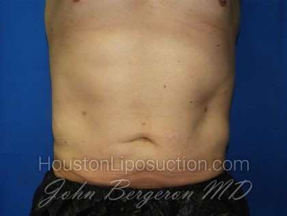 Liposuction Before & After Patient #3184