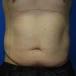 Liposuction Before & After Patient #3184