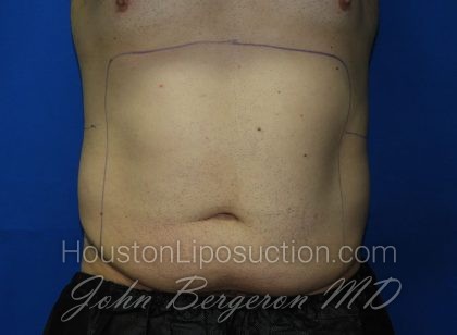 Liposuction Before & After Patient #3184