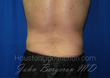 Liposuction Before & After Patient #3184
