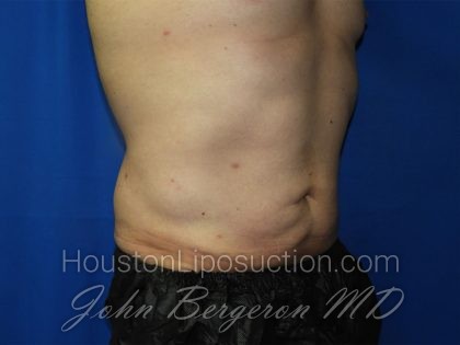 Liposuction Before & After Patient #3184