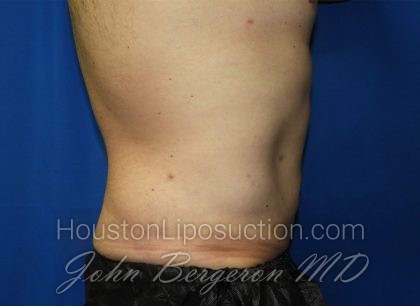 Liposuction Before & After Patient #3184