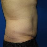 Liposuction Before & After Patient #3184