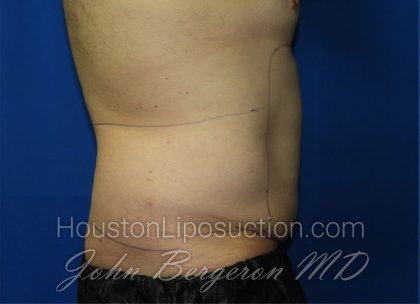 Liposuction Before & After Patient #3184