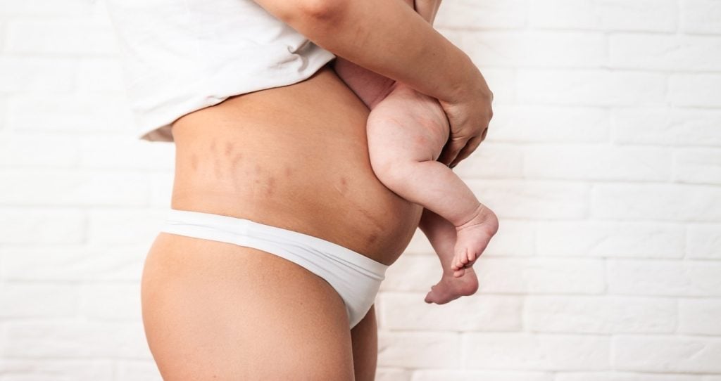 Liposuction After Having a Baby in Houston