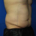 Liposuction Before & After Patient #3184