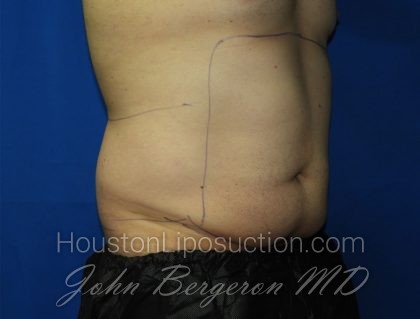 Liposuction Before & After Patient #3184