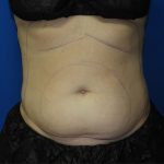 Liposuction Before & After Patient #3220