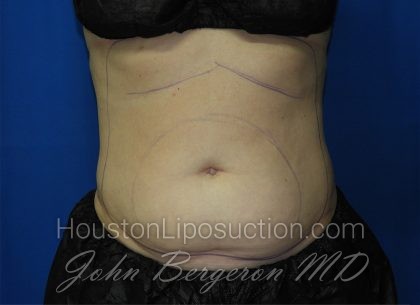 Liposuction Before & After Patient #3220