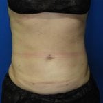 Liposuction Before & After Patient #3220